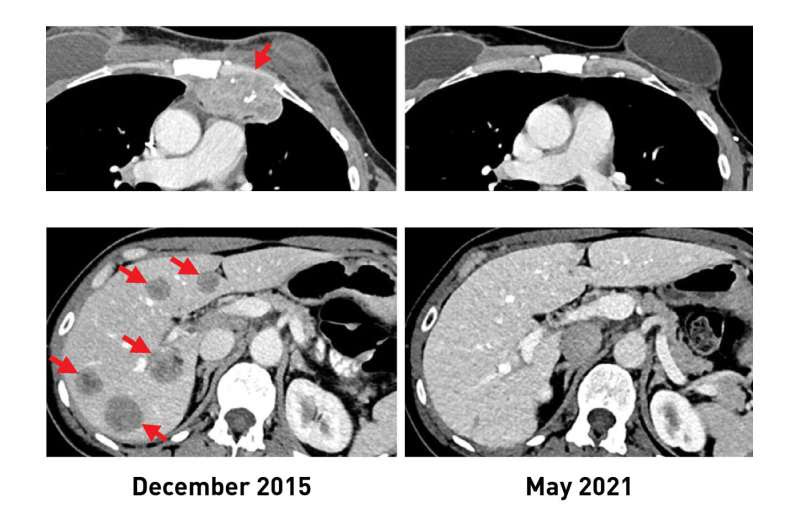 NIH study advances personalized immunotherapy for metastatic breast cancer