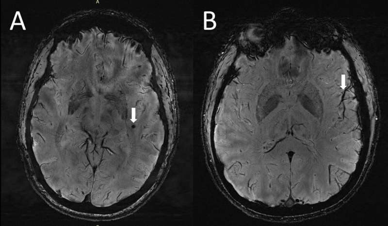 Ultra-high-res MRI reveals migraine brain changes