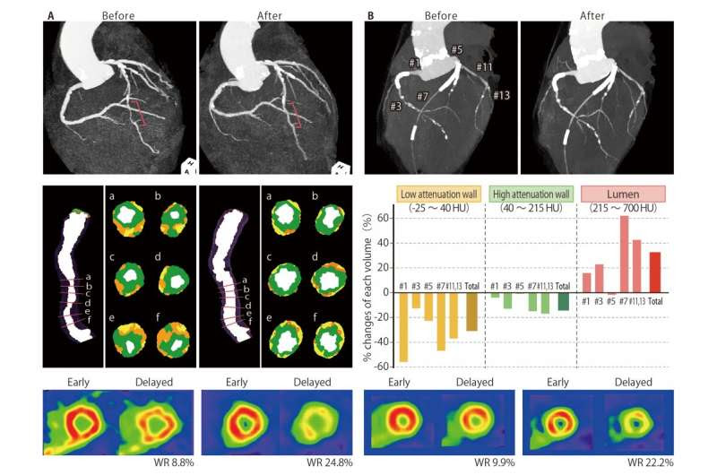 A dietary supplement leads to remarkable regression in atherosclerotic lesions