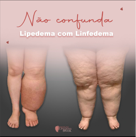 Com LIPEDEMA - corpo e mente sãos - Drenaclinic