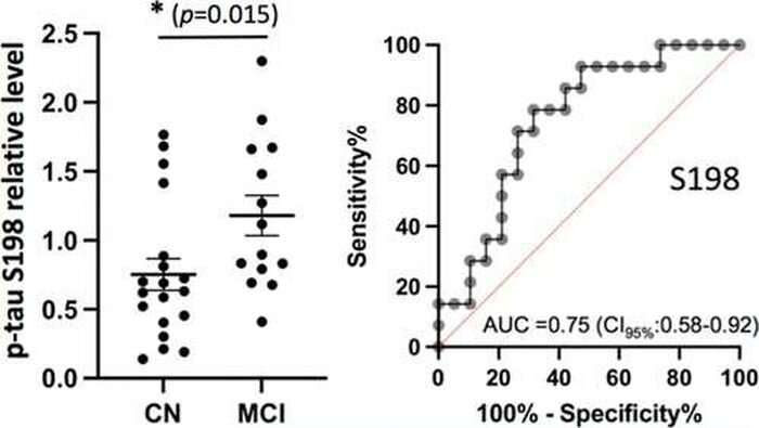 New biomarker could help diagnose Alzheimer's disease early