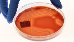 Jean Lee, a PhD student at Melbourne's Doherty Institute, displays the superbug Staphylcocus epidermidis on an agar plate in Melbourne on September 4, 2018. - A superbug resistant to all known antibiotics that can cause "severe" infections or even death is spreading undetected through hospital wards across the world, scientists in Australia warned on September 3. Researchers at the University of Melbourne discovered three variants of the multidrug-resistant bug in samples from 10 countries, including strains in Europe that cannot be tamed by any drug currently on the market. (Photo by William WEST / AFP)        (Photo credit should read WILLIAM WEST/AFP via Getty Images)