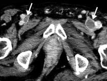 Veia cava inferior (VCI) e trombose venosa profunda periférica (TVP) em um homem de 78 anos com COVID-19 com edema nas pernas e dor abdominal.  Imagens axiais de TC com contraste mostram defeitos de enchimento nas veias femorais comuns bilaterais (setas brancas).  Imagem cortesia de Margarita Revzin et al.