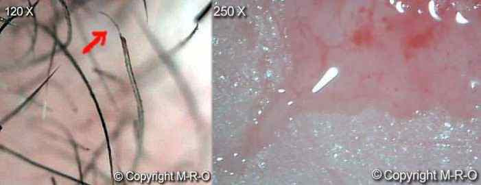 morgellons-infection6.jpg (8677 Byte)