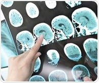 Global study on stroke prevention in high-risk AF patients