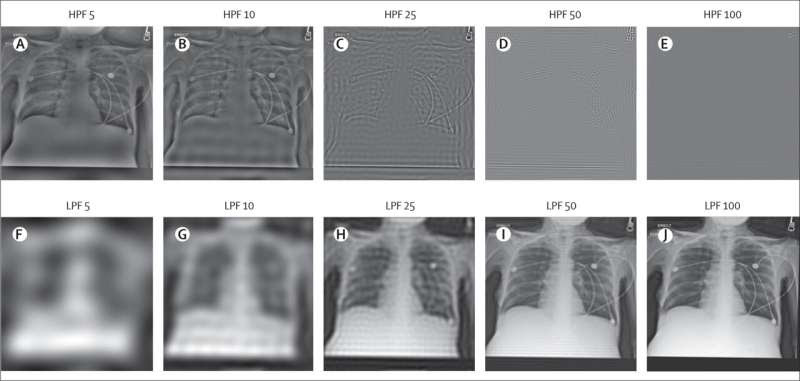 Artificial intelligence predicts patients’ race from their medical images