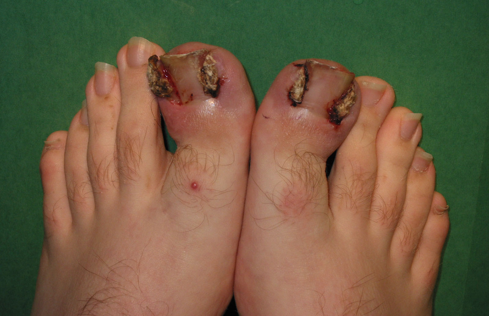 Doctors Warn: Deadly Infection Looks Just Like Nail Fungus