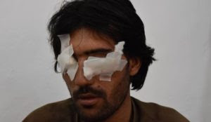 Pakistan: Man blinded for “un-Islamic” love relationship by his father and brothers as they scream “Allahu akbar”