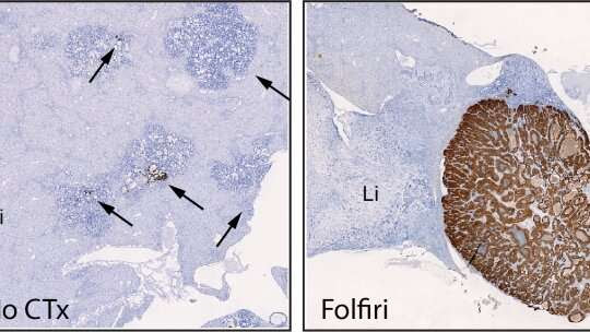 Scientists unravel the key to colon cancer relapse after chemotherapy