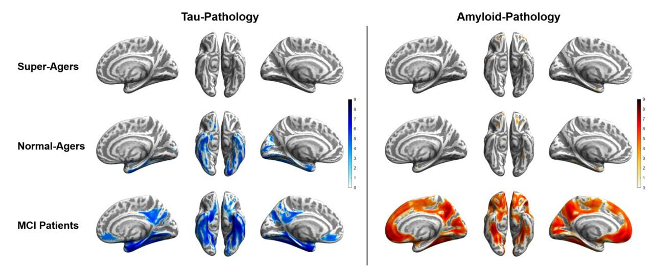 The SNMMI Image of the Year. Tau (blue) and amyloid (orange) distribution patterns for super-agers, normal-agers and MCI patients