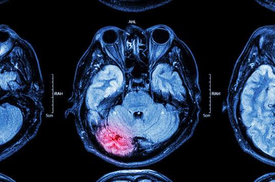 imagen de una resonancia magnética de un accidente cerebrovascular 