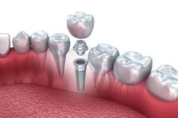 Bioengineered dental implants