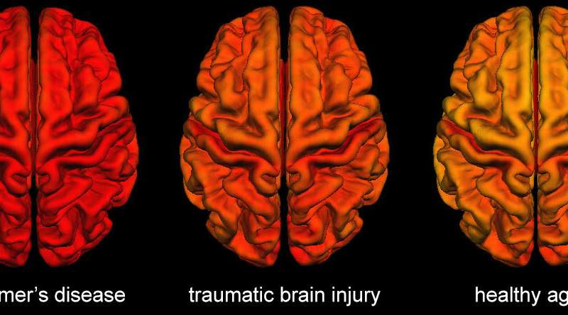 Brain changes following traumatic brain injury share similarities with Alzheimer's disease