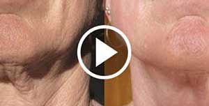 Loose Jowls? Do This Every Day (Watch)