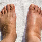 How To Get Rid of Swollen Feet Within 4 Days
