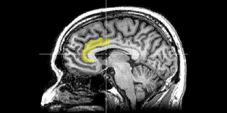 Sagittal MRI slice with highlighting indicating location of the anterior cingulate cortex. (Photo credit: Geoff B. Hall)