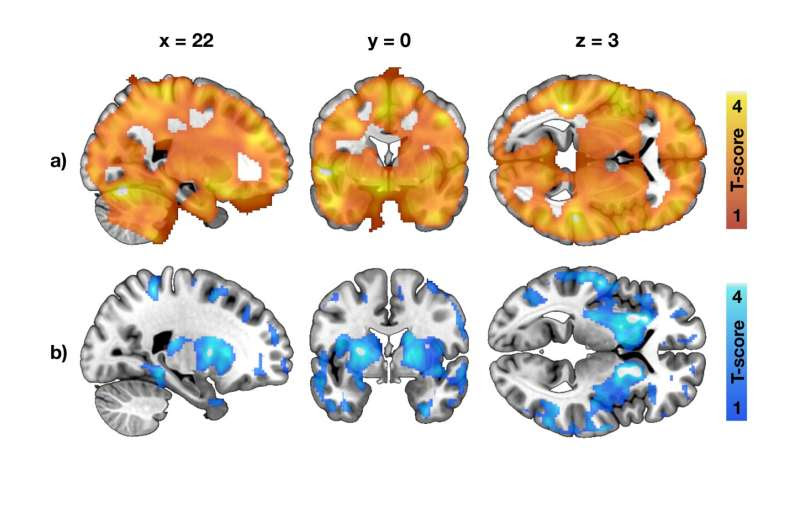 Brain reveals the risk for developing obesity