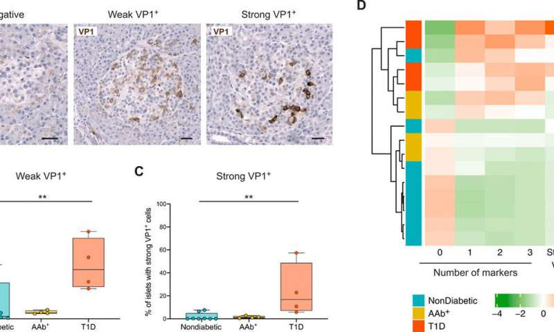 Relationship between type 1 diabetes, interferon response and viral infection is first step toward preventive therapies