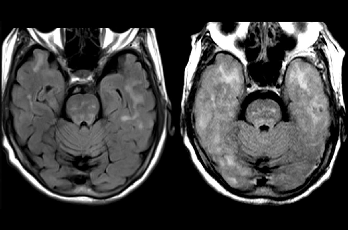 MRI brain scans show swelling