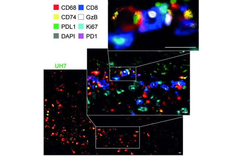 Predicting whether bowel cancers will respond to immunotherapy