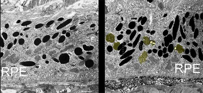 Recycling of the eye's light sensors is faulty in progressive blindness of older adults