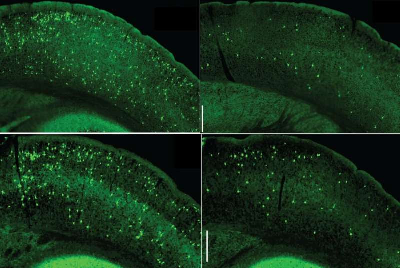 Key signaling pathway in immune cells could be new Alzheimer's target