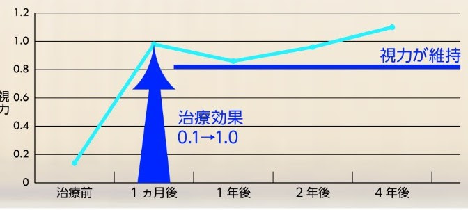 iOK®近視抑制グラフ