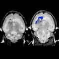 Targeted Nanochains in Brain Tumor