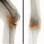 Bone on Bone Knee Pain? Do This Once A Day