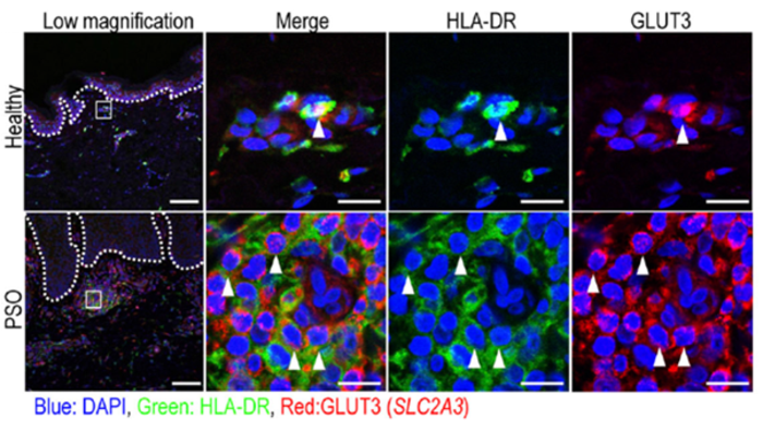 Immunofluorescence labeling of healthy and psoriatic patient skin.