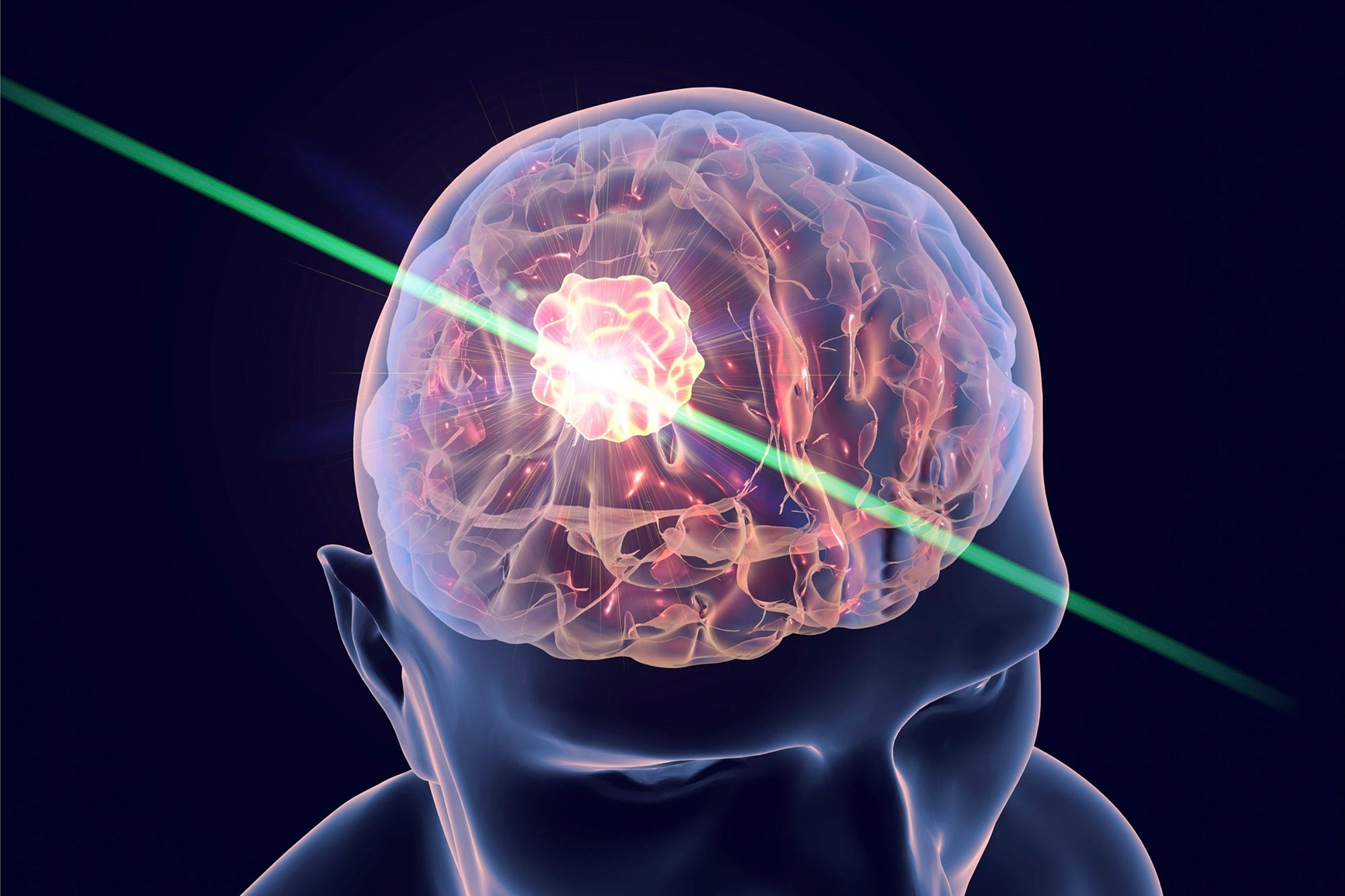 Brain Cancer Laser Treatment