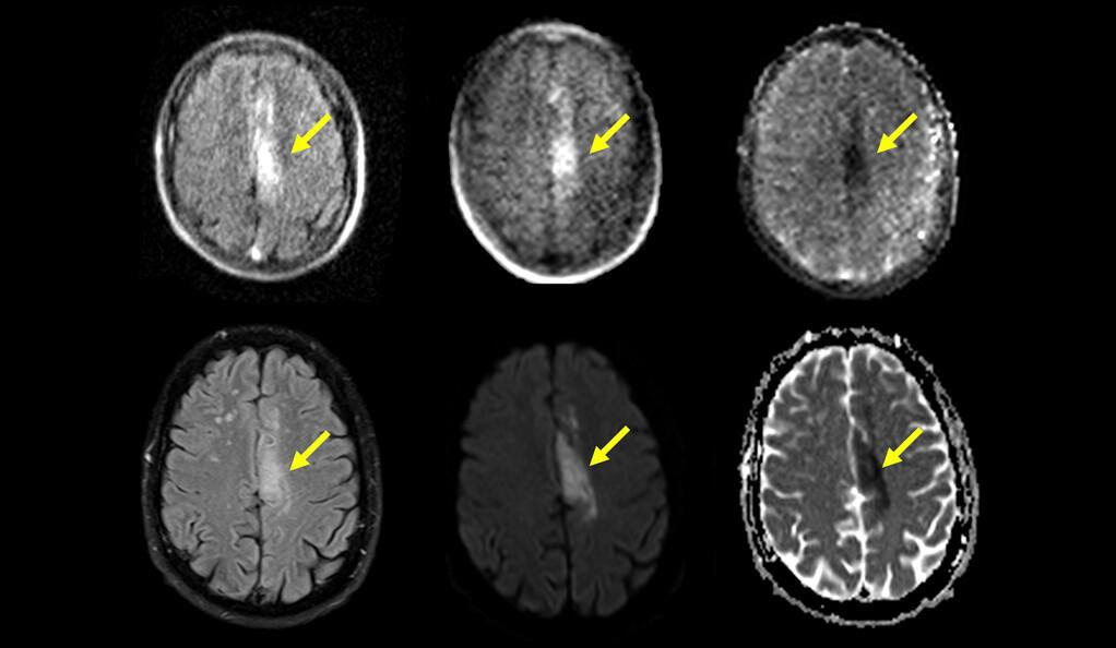Portable MRI (top row) can detect and characterize ischemic stroke identified by standard MRI (bottom row)