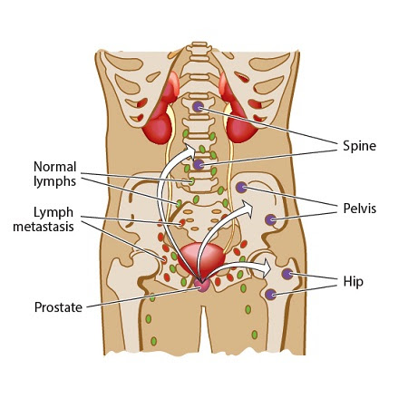 diagram of body with metastatic prostate cancer