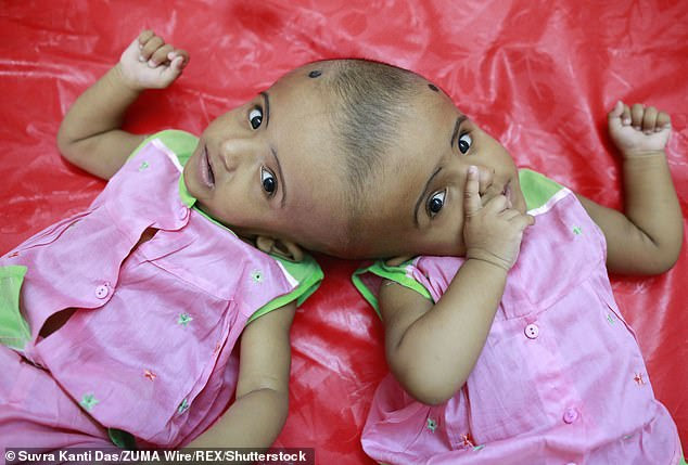 Conjoined twins occur once every 200,000 live births, and even if they survive birth, their prognosis is generally poor