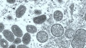 Monkeypox case reported in man whose 'primary risk factor' was close, nonsexual contact at a crowded outdoor event