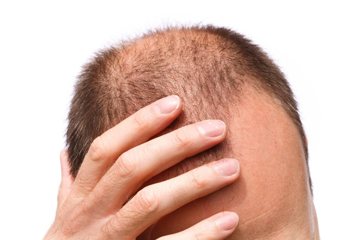 A clinical trial suggests a topical solution is effective at regrowing hair