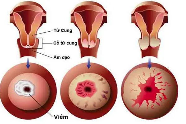 Hình ảnh bệnh viêm lộ tuyến cổ tử cung
