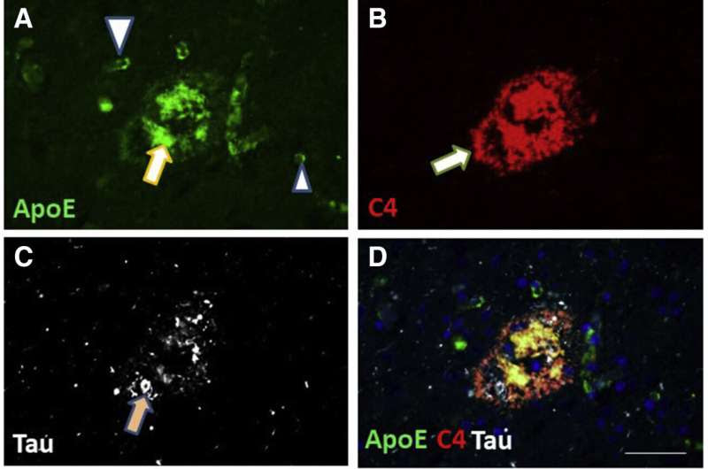 Study now links non-mutated Apolipoprotein E to dementia in the aging brain