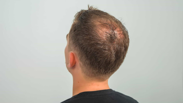 Médicos alertam que inúmeros doentes sofrem de perda de cabelo pós-Covid