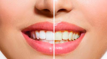 Qué alimentos manchan tus dientes... y cuáles los protegen