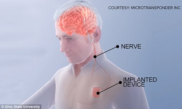 The Vivistim system uses two implants - one in the back of the neck and one in the chest - to send electrical signals through the vagus nerve to the brain, encouraging neuroplasticity