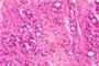 Microfotografía que revela cambios histopatológicos indicativos de adenocarcinoma de la próstata