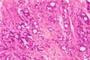 Microfotografía que revela cambios histopatológicos indicativos de adenocarcinoma de la próstata Microfotografía que revela cambios histopatológicos indicativos de adenocarcinoma de la próstata