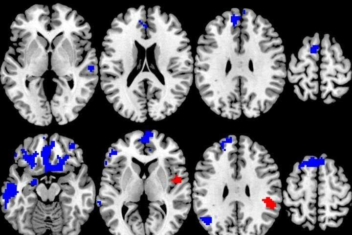 Which OCD treatment works best? New brain study could lead to more personalized choices