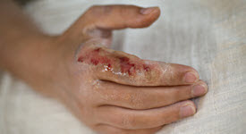 Photo of a hand with third degree burns