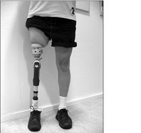 Osseoanchored Prostheses for the Rehab of Amputees