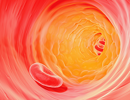 cholesterol plaque in artery