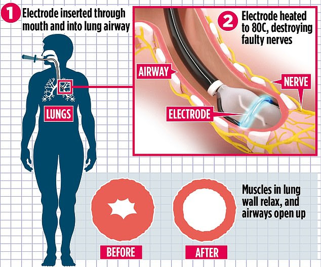 The treatment works by inserting a device called a bronchoscope through the mouth and into the lungs. The thin tube carries a deflated balloon is fed into the lungs. Once the balloon is in the correct position, it is inflated and theÂ tiny electrodes emit radiofrequency energy