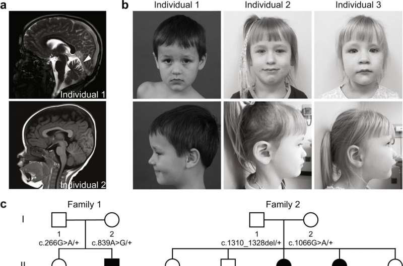 Scientists discover a rare neurological disease involving cellular recycling