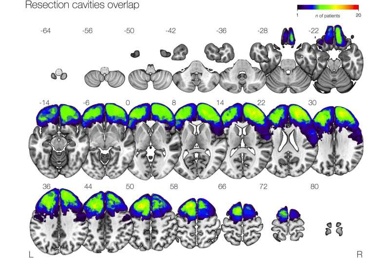 Researchers find connections in the brain involved in epileptic seizures